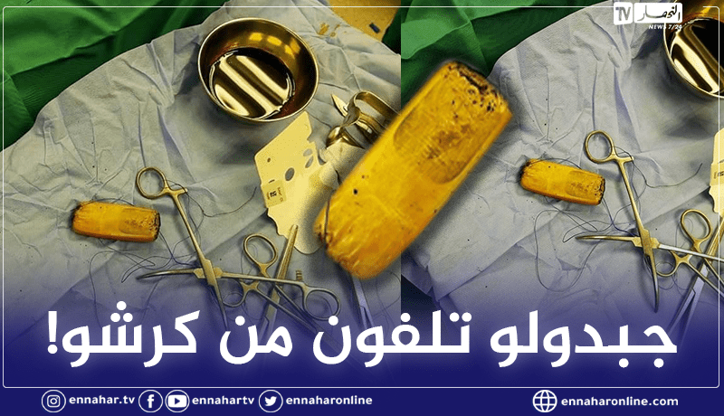 مصر.. إستخراج هاتف محمول من معدة مريض!