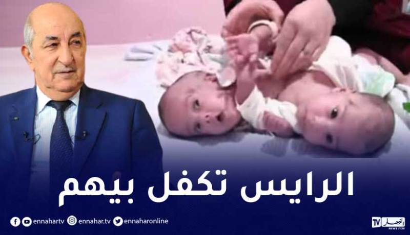 رئيس الجمهورية يتكفل شخصيا بفصل توأمين وإجراء عملية جراحية بتركيا