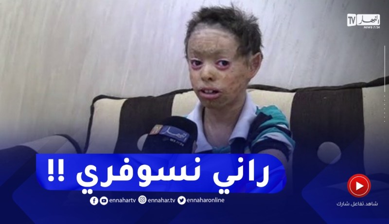 “مرض نادر يحول الطفل حسين لسمكة..”راني نسوفري نخاف تبهدلني المعلّمة !!
