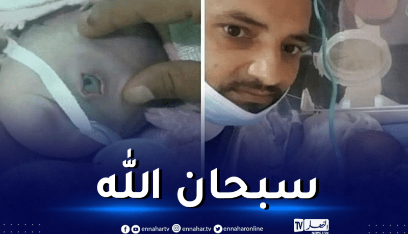 فيديو.. ولادة طفل بعين واحدة!