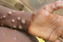 الصحة العالمية: لا خوف حاليا من تحوّل جدري القردة إلى جائحة