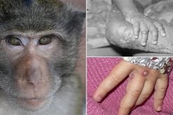 خطير وسريع الانتشار.. جذري القردة يتفشى في العالم وهذه أعراض الإصابة