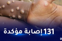 منظمة الصحة العالمية تكشف إجمالي الإصابات بجدري القردة ومدى إنتشاره