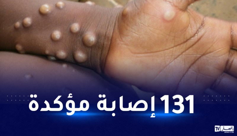 منظمة الصحة العالمية تكشف إجمالي الإصابات بجدري القردة ومدى إنتشاره