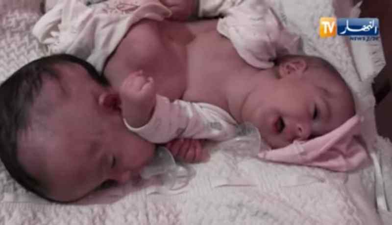 نجاح فصل التوأم السيامي صفاء وشفاء بمستشفى في تركيا بعد ان تكفل بهما رئيس الجمهورية