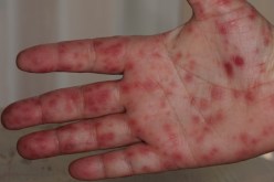 تشبه الجدري وتستهدف الأطفال.. حمى الطماطم تثير قلق العالم