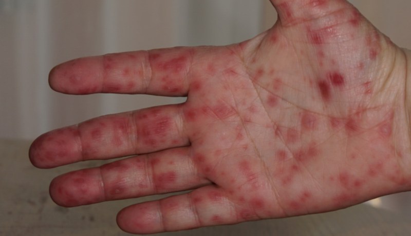 تشبه الجدري وتستهدف الأطفال.. حمى الطماطم تثير قلق العالم