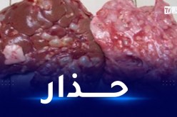 وزارة الصحة تحذّر من الكيس المائي