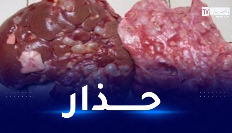 وزارة الصحة تحذّر من الكيس المائي