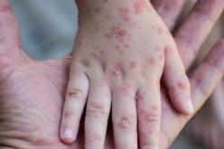 الصحة العالمية تُعلن حالة الطوارئ بسبب جدري القردة