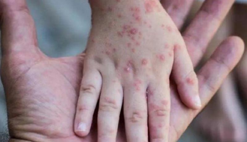 تسجيل أول إصابة بجدري القردة في الصين
