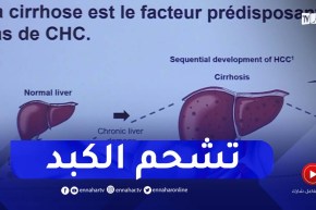 “تشحم الكبد”.. مرض يهدد صحة الجزائريين بسبب النظام الغذائي