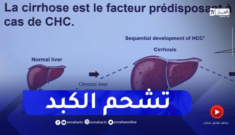 “تشحم الكبد”.. مرض يهدد صحة الجزائريين بسبب النظام الغذائي
