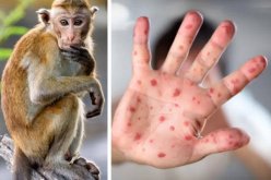 الصحة العالمية: تسجيل أكثر من 5 آلاف إصابة بجدري القرود في العالم