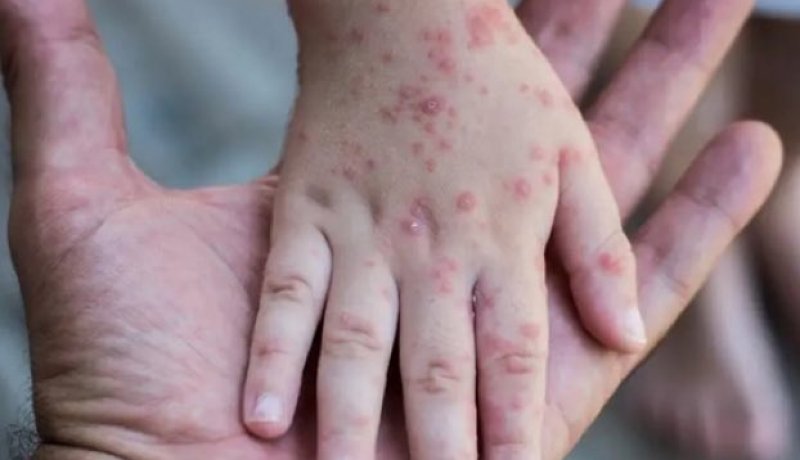 منظمة الصحة العالمية تدعو إلى زيادة إنتاج لقاحات جدري القردة