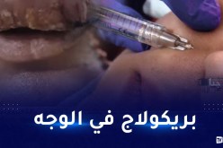 “الفيلر” و”الفوسات” داخل صالونات الحلاقة.. وزارة التجارة تحذر!