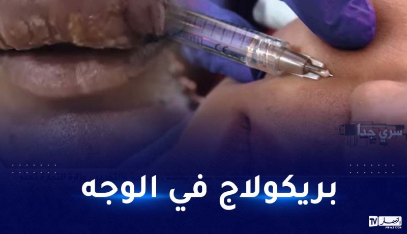 “الفيلر” و”الفوسات” داخل صالونات الحلاقة.. وزارة التجارة تحذر!