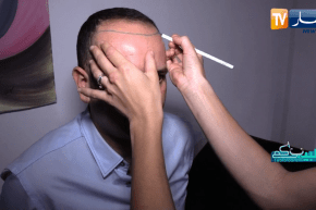 طبيبكم: تساقط الشعر .. الأسباب والعلاج “الجزء 1”