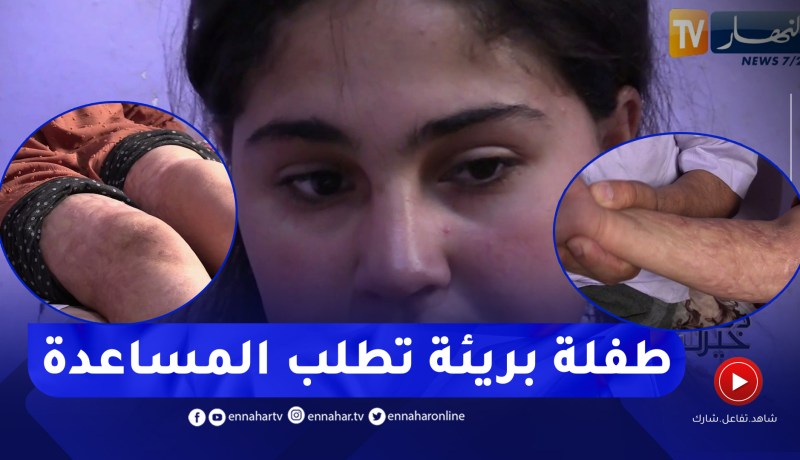 دلال خير: حادثة في المنزل شوّهـ.ت جسد الطفلة جوهرة.. تطلب من المحسنين مساعدها في العلاج