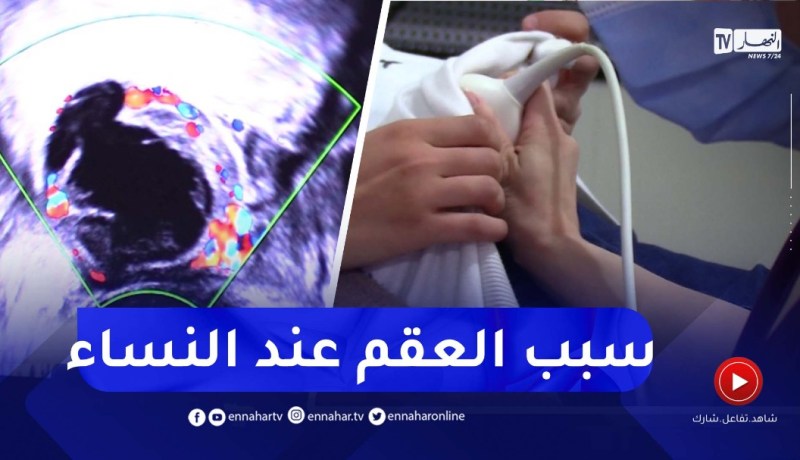 بطانة الرحم المهاجرة.. تسبب لـ30 بالمئة من النساء العقم