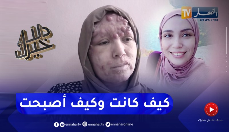 دلال خير: مرض جلدي بسيط يتحول إلى نوع خطير من سرطان الجلد.. إيمان تتجرع مرارة الألم