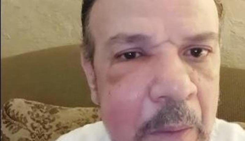 أحمد سلامة يكشف مفاجأة عن إصابته بورم خطير في الوجه