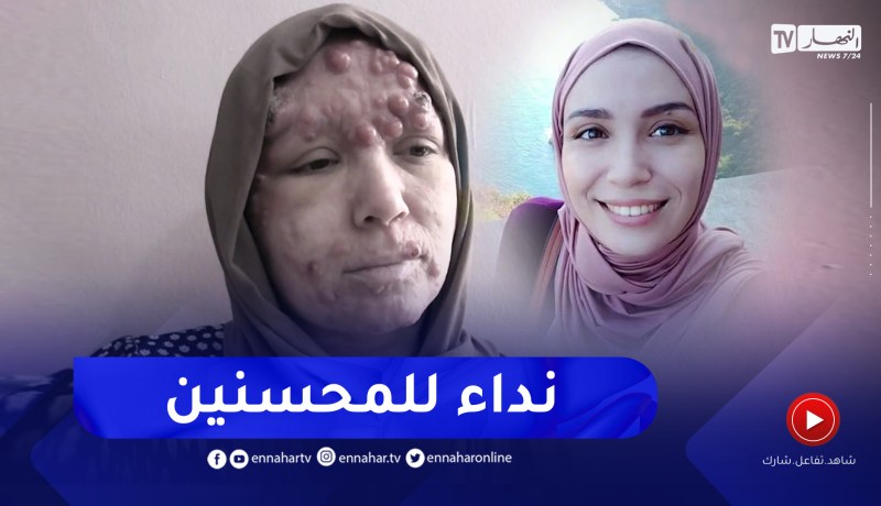 البليدة: مرض سرطان الجلد يُذهب إبتسامة إيمان ويقلب حياتها رأسا على عقب