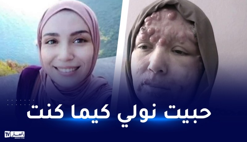 بالفيديو.. مرض نادر يسرق إبتسامة إيمان وأملها في الجزائريين