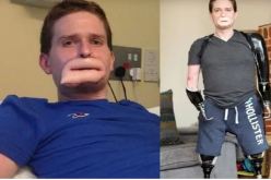 بالفيديو.. بكتيريا مرعبة تشوه رجلا وتقتل 9 أطفال في بريطانيا