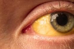 علامة “غريبة” في العين قد تكون مؤشرا لسرطان خطير