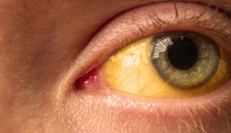 علامة “غريبة” في العين قد تكون مؤشرا لسرطان خطير