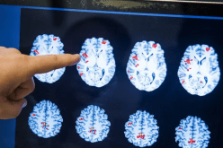 إصابات كورونا الحادة تسبب شيخوخة الدماغ