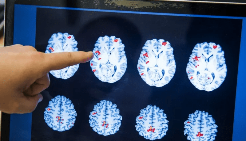 تسجيل إصابة بـ”مرض فتّاك” يدمّر دماغ البشر