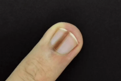 علامة بالأظافر تنذر بالإصابة بهذا النوع من السرطان