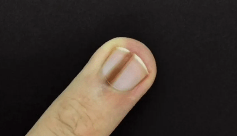 علامة بالأظافر تنذر بالإصابة بهذا النوع من السرطان