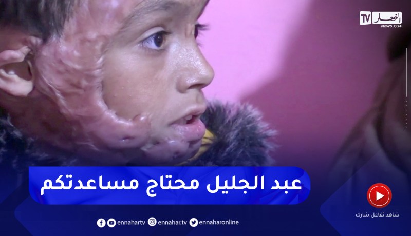 البيض: عائلة الطفل عبد الجليل تطالب المساعدة لإجراء عملية تجميلية لإبنها من آثار الحروق