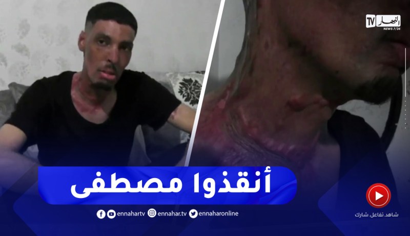 النعامة / مصطفى .. شاب تعرض لحروق يناشد المحسنين مساعدته لإجراء عملية جراحية