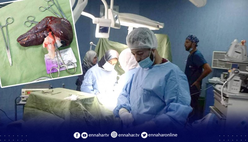 قالمة: فريق طبي بمستشفى الأم والطفل ينجح في استئصال طحال في المرحلة الرابعة من التضخم