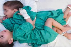 نجاح عملية فصل التوأم السيامي السوري وتوقعات بوفاة أحدهما