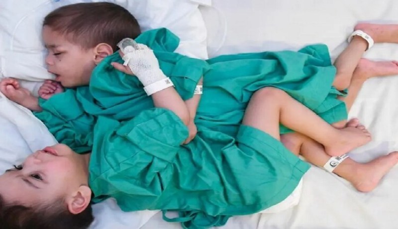 نجاح عملية فصل التوأم السيامي السوري وتوقعات بوفاة أحدهما