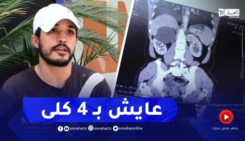 في حالة نادرة.. قصة حسام يعيش بأربع كلى سليمة