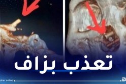 رجل يكتشف مفاجأة صادمة داخل جمجمته!