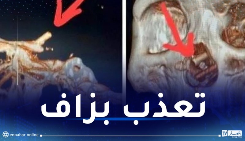 رجل يكتشف مفاجأة صادمة داخل جمجمته!