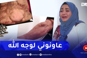 دلال خير: تشوهات جسدية جراء حروق من الدرجة الثالثة تسبب أزمة نفسية لرميساء