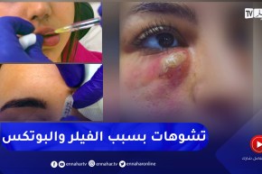 مجتمع : حقن “البوتكس والفيلر” .. نهايات مأسوية لنساء تبحثن عن الجمال