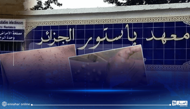 معهد باستور : بيان هام حول مرض جدري القردة
