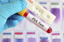 اكتشاف طبي لتشخيص سرطان البروستات في 15 دقيقة