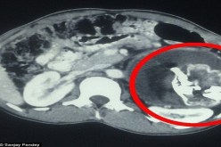 أفغانستان.. استخراج جنين من بطن رضيع