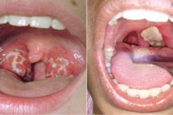 تعرف على أعراض وأسباب الإصابة بداء الدفتيريا أوالخناق 