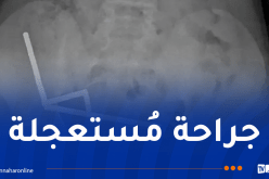 صبي يبتلع 100 مغناطيس!!